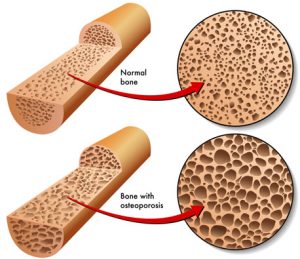 Prevent osteoporosis: Normal bone versus a bone with osteoporosis