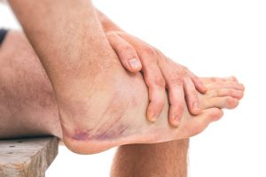 Recurrent ankle sprains go through the stages of soft tissue healing